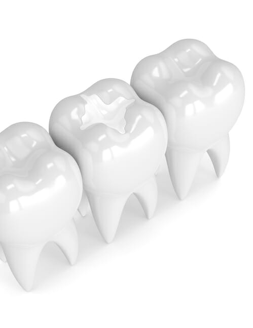 Dental Sealant | Tooth Sealants